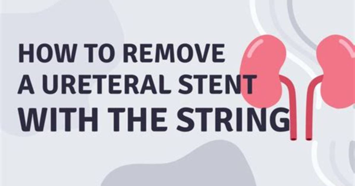 When to Remove Ureteral Stent?