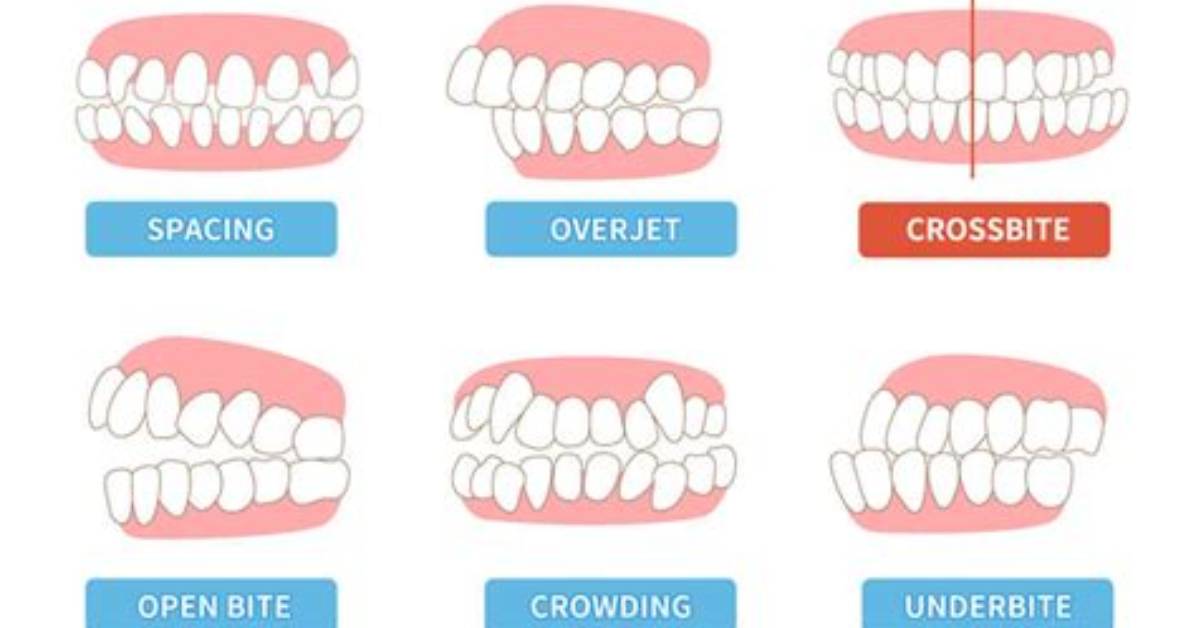When to Treat Crossbite?