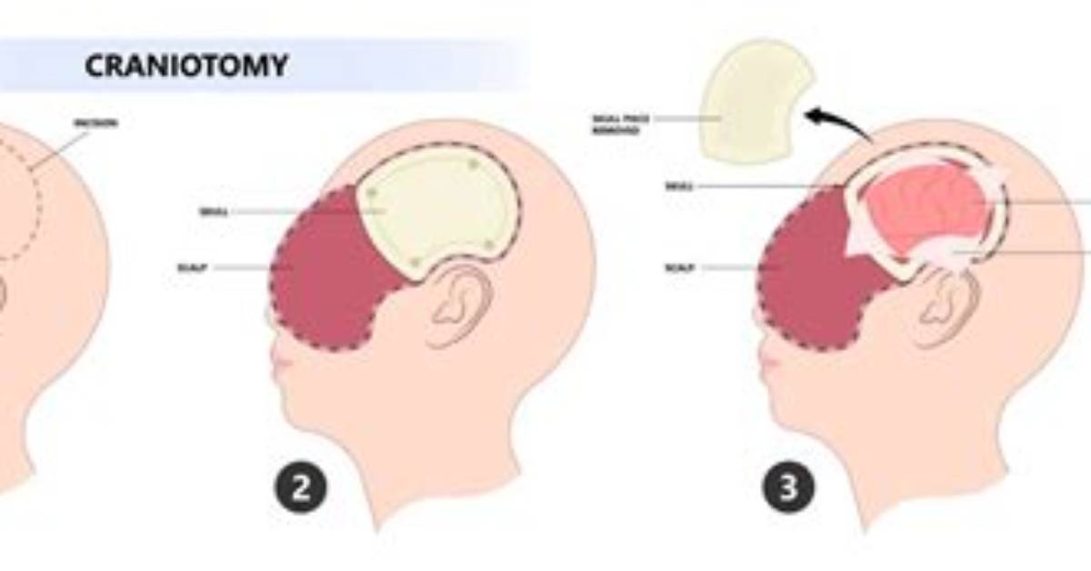 When to Use Craniotomy?