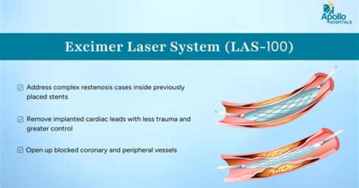 When to Use Excimer?