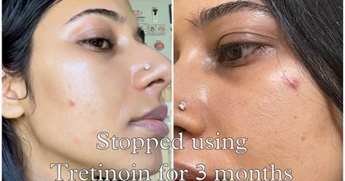 When Tretinoin Stop Working?