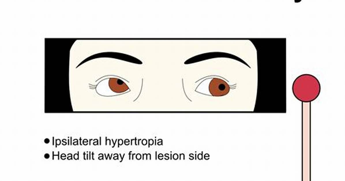 When Trochlear Nerve Is Damaged?