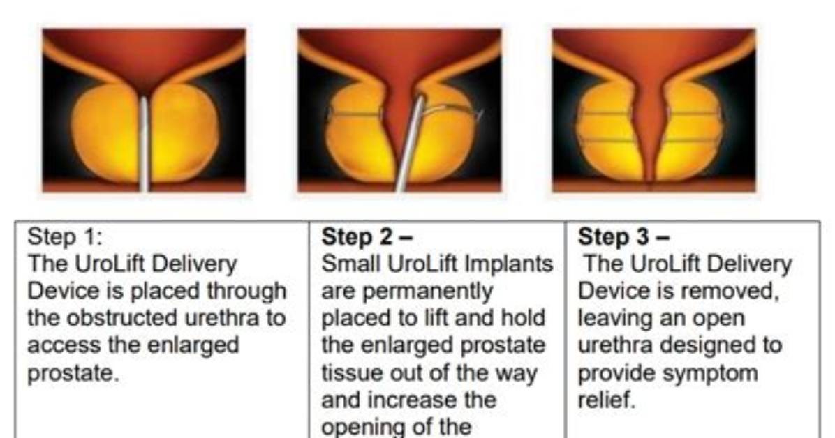 When Urolift Doesn't Work?