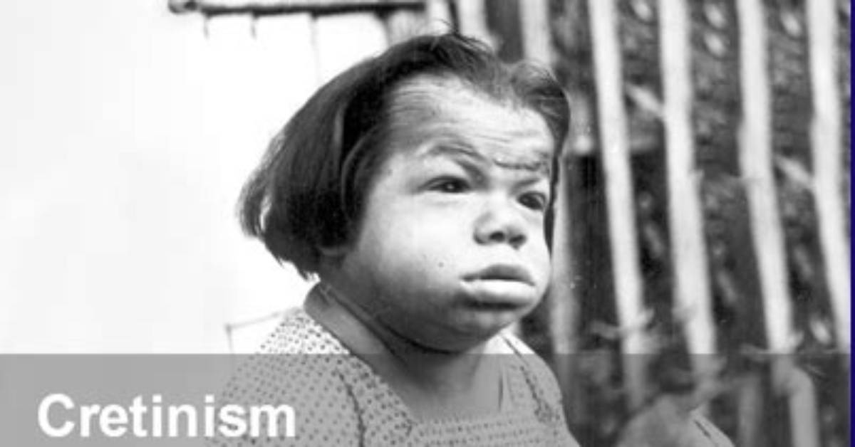 When Was Cretinism Discovered?