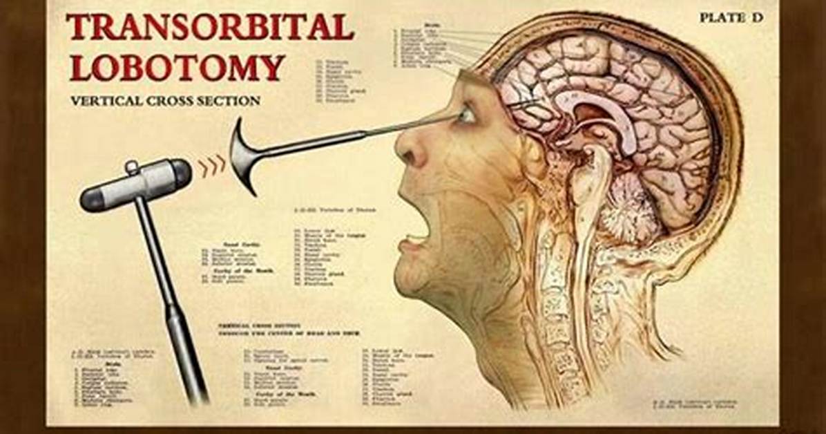 When Was Frontal Lobotomy Invented?
