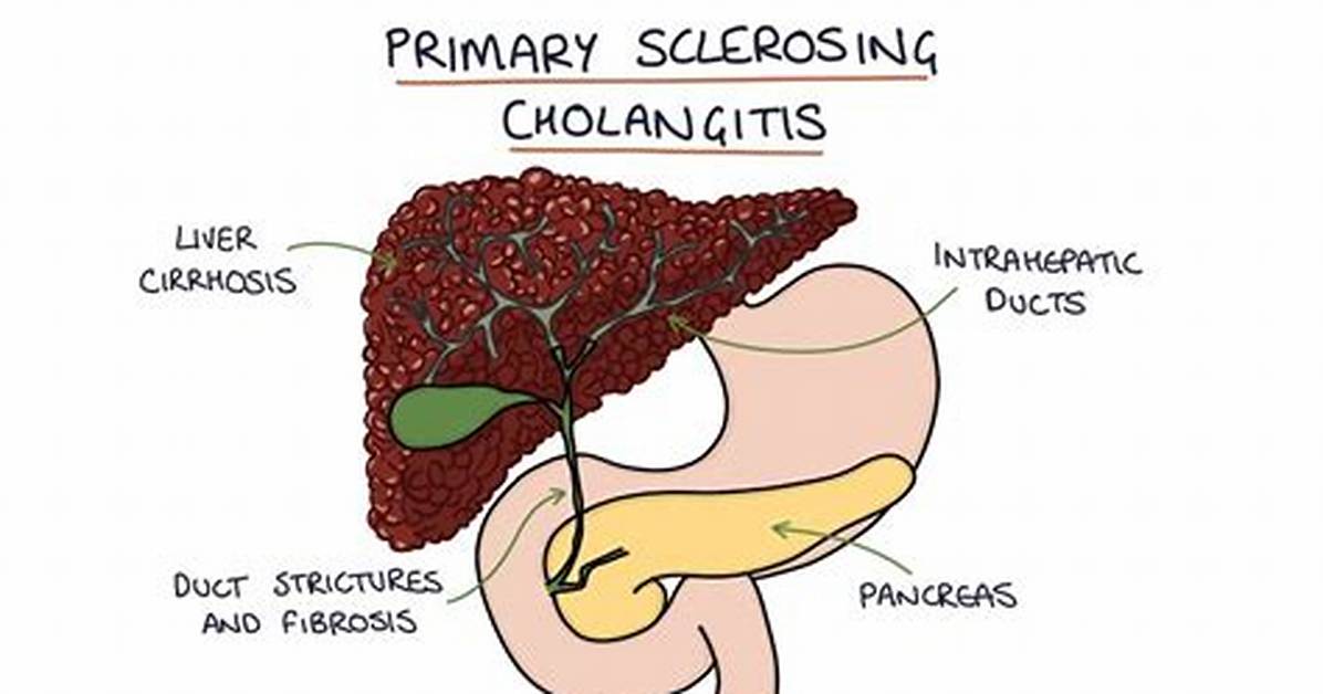 When Was Sclerosing Cholangitis Discovered?