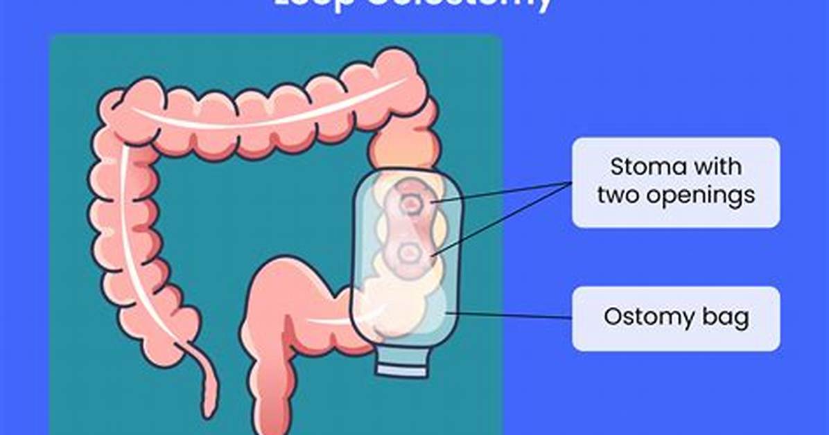 When Was the First Ostomy Performed?