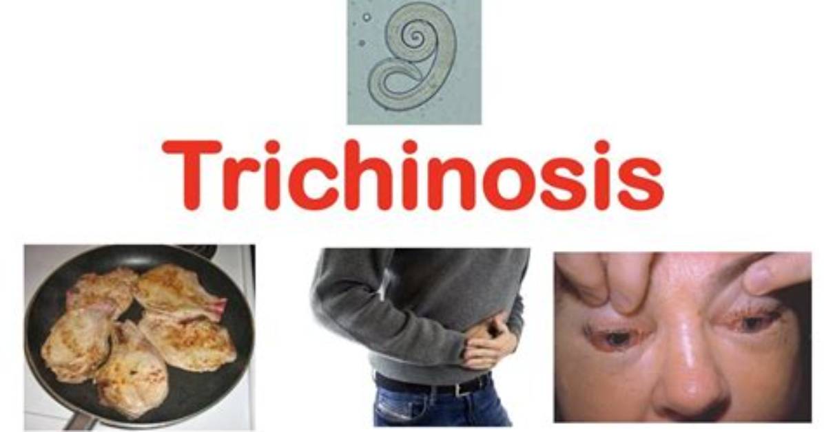 When Was Trichinosis Discovered?
