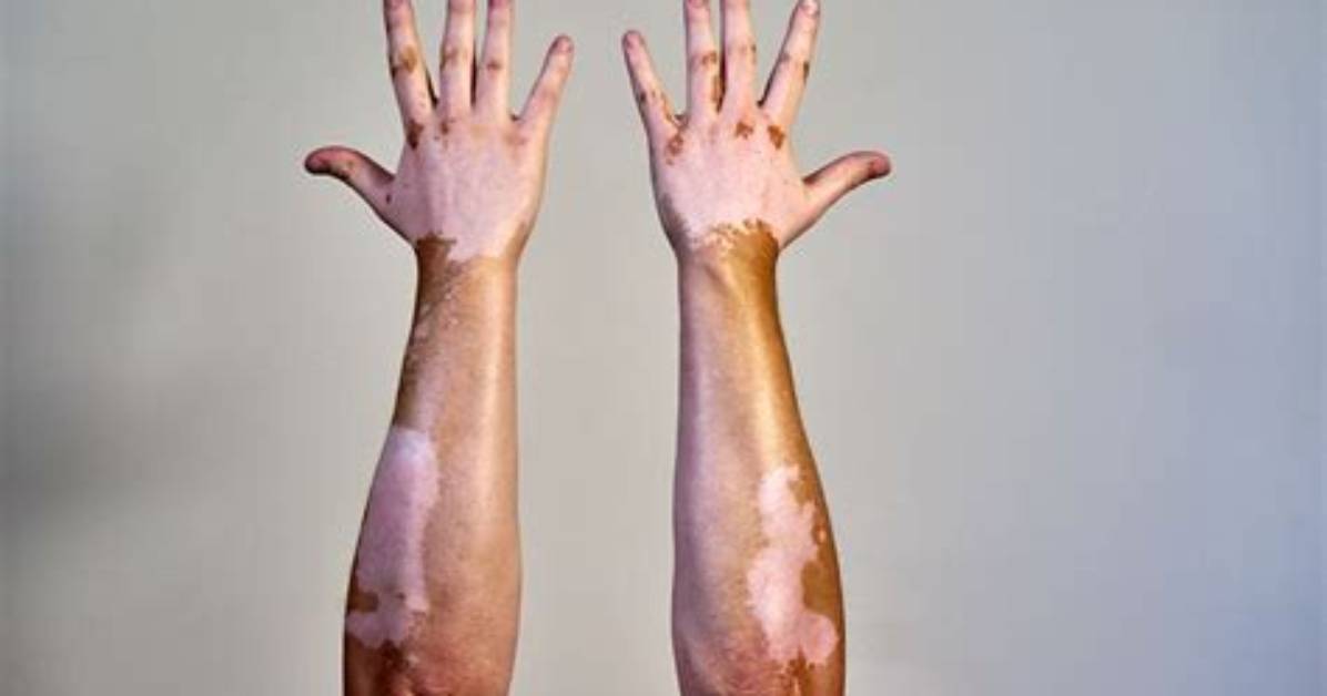 When Was Vitiligo Discovered?