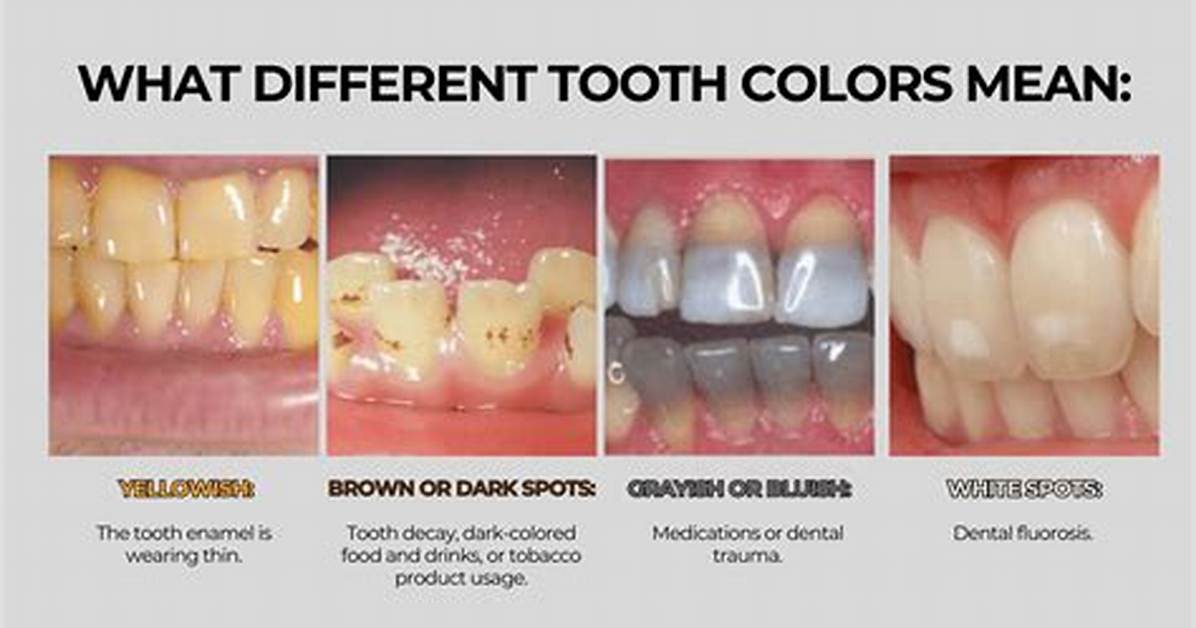 When Will Dead Tooth Change Color?