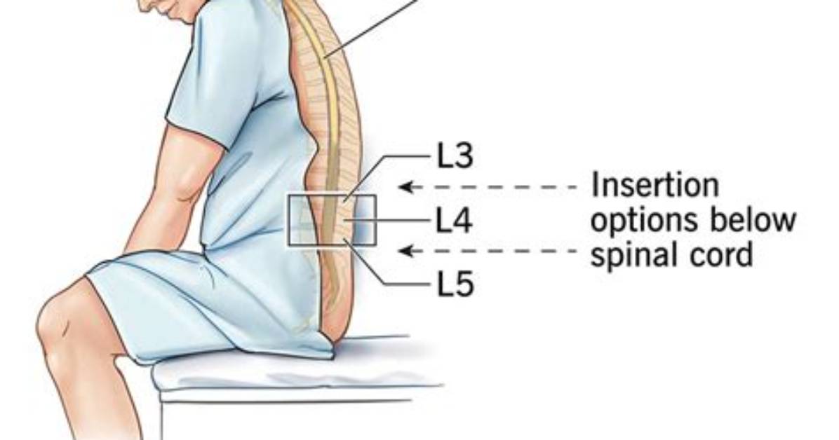 When You Get an Epidural How Do You Pee?