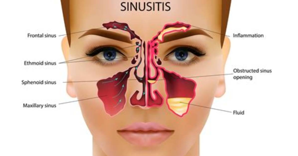 When Your Sinuses Are Draining?