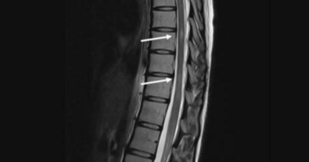 Where Are Ms Spinal Lesions Located?