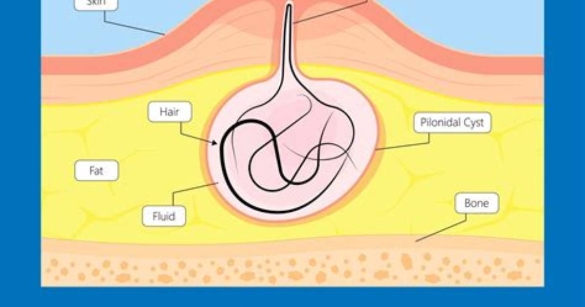 Where Are Pilonidal Cysts Located?