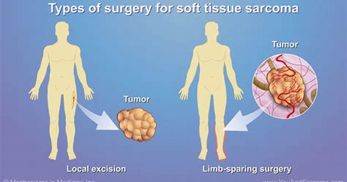 Where Are Sarcomas Usually Found?