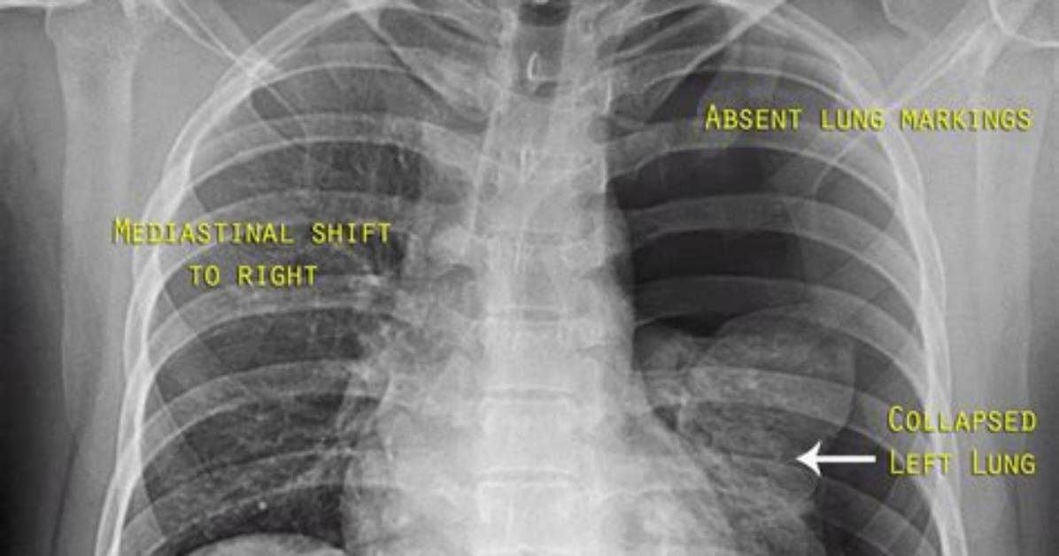 Where Can Pneumothorax Be Found?