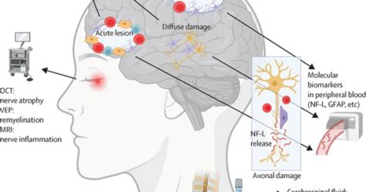 Where Can Sclerosis Be Found?