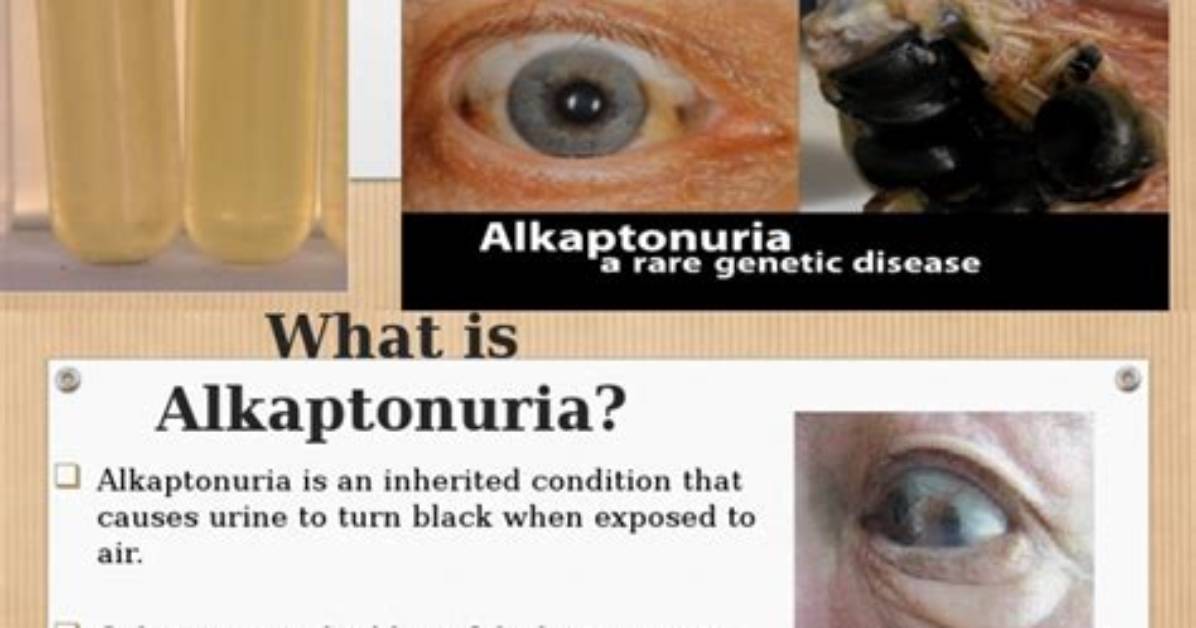 Where Did Alkaptonuria Come from?