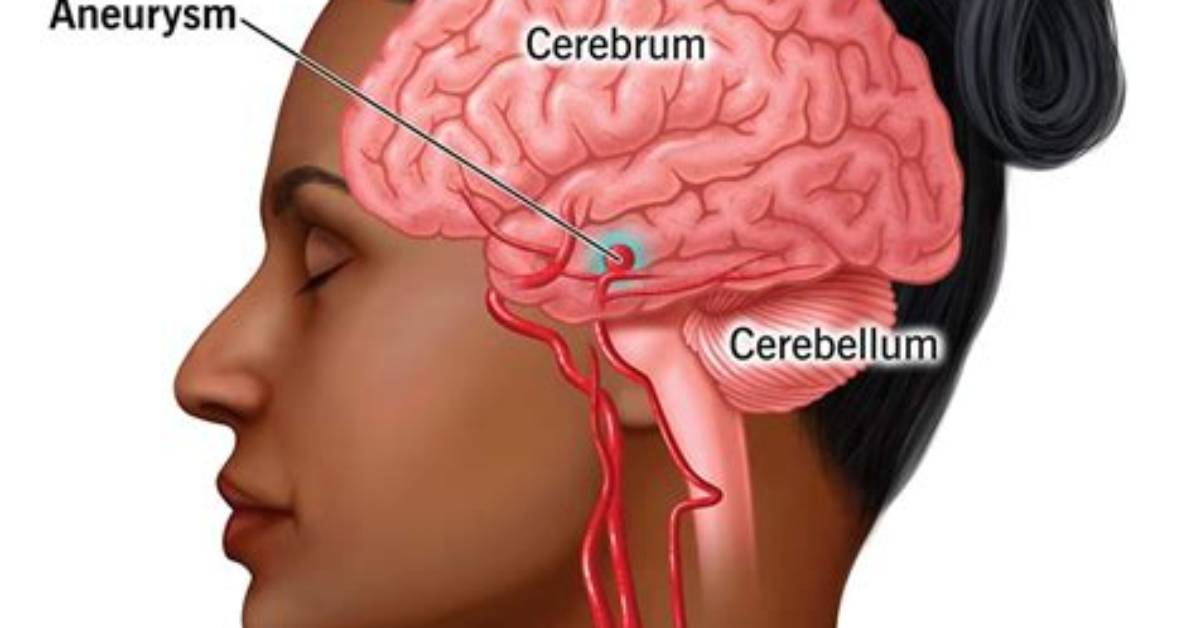 Where Do Aneurysms Come from?