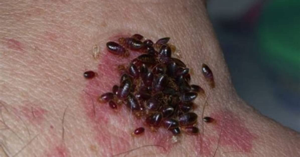 Where Do Bed Bugs Like to Bite