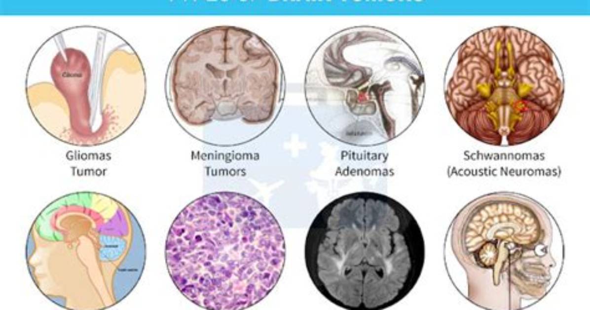 Where Do Brain Tumours Spread to?