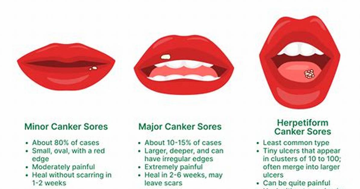 Where Do Canker Sores Come from?