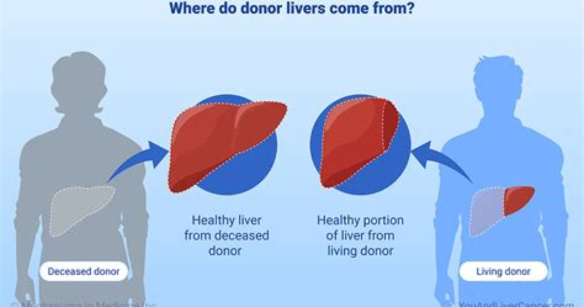 Where Do Donor Livers Come from?