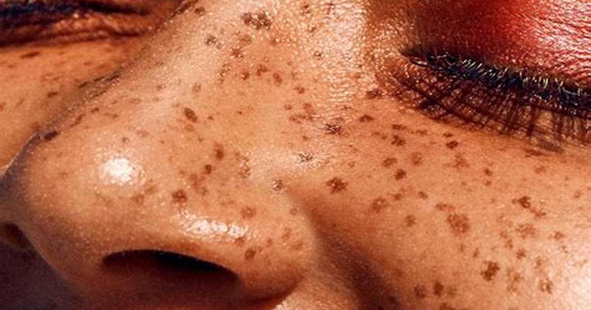Where Do Freckles Come from National Geographic