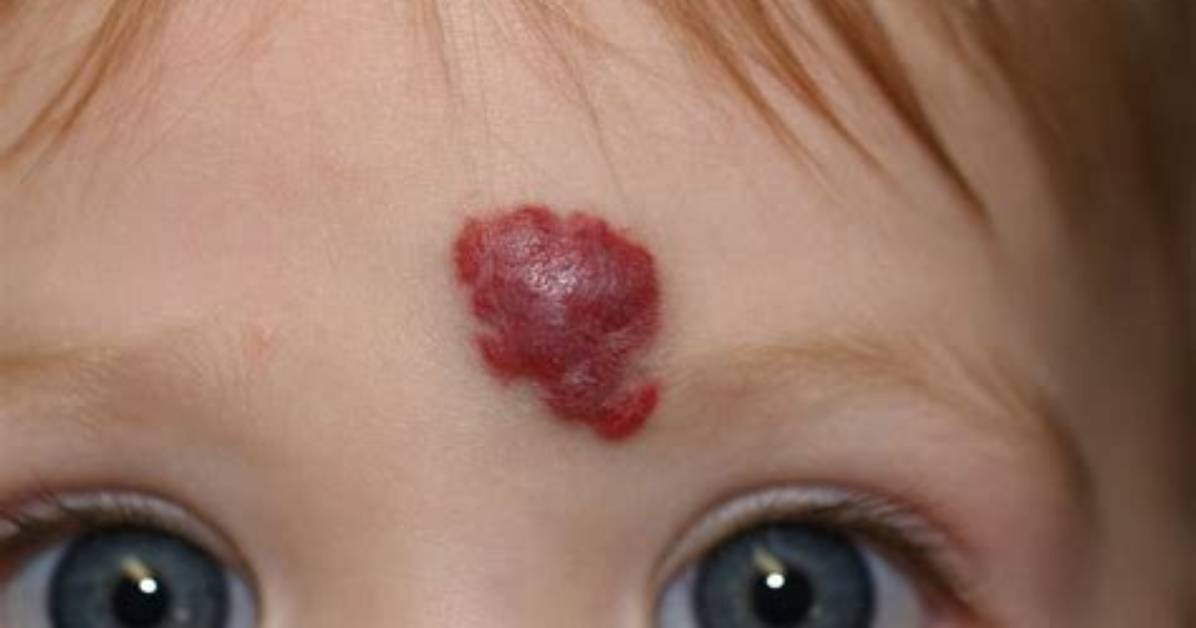 Where Do Hemangiomas Come from?