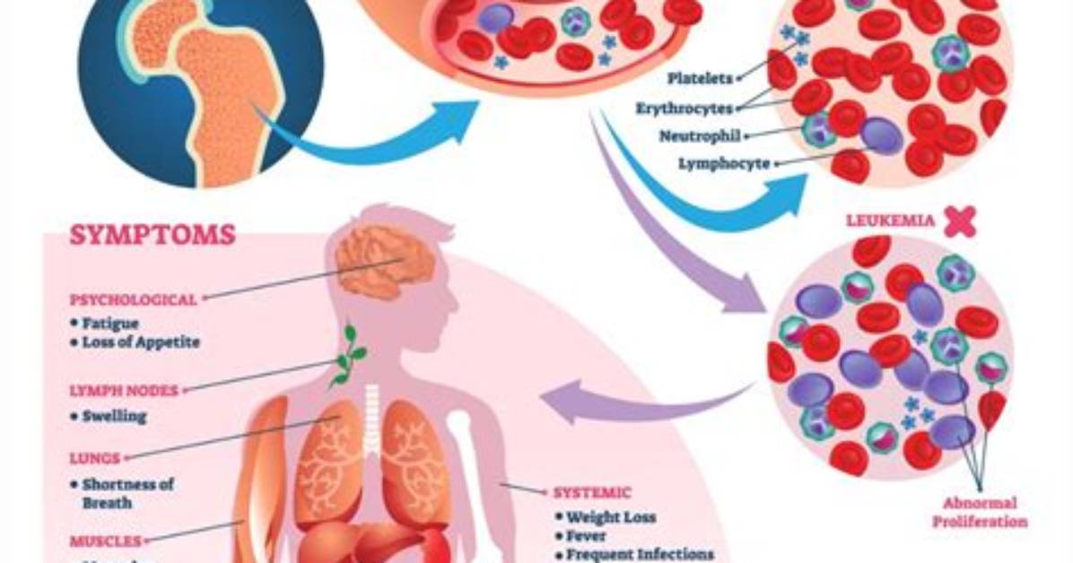 Where Do Leukemias Come from?