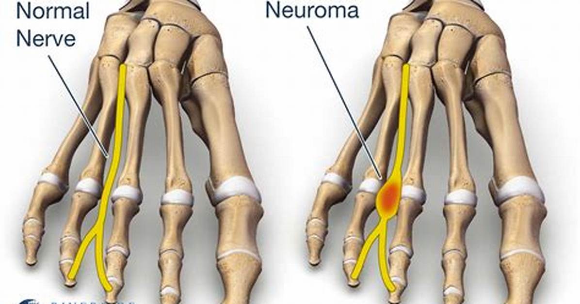 Where Do Neuromas Occur?