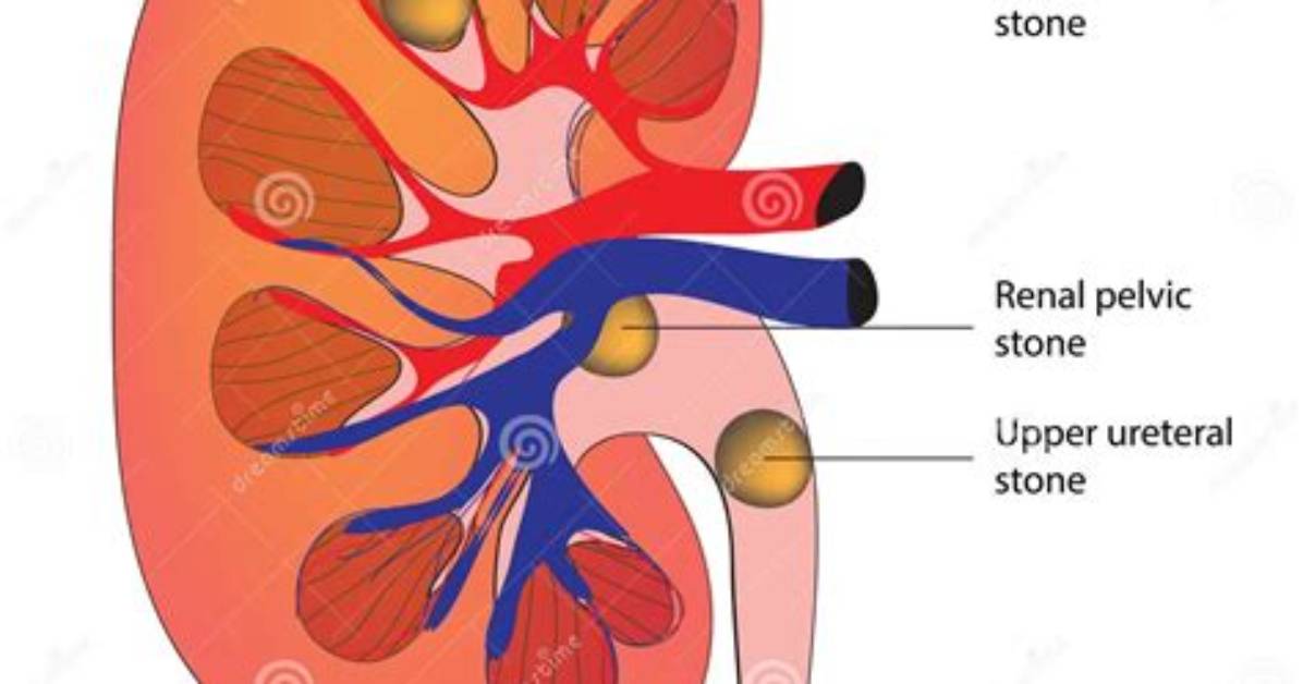 Where Do Renal Calculi Form?