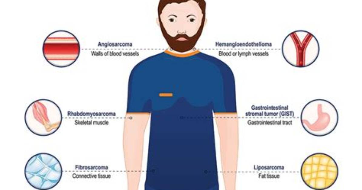Where Do Sarcomas Originate