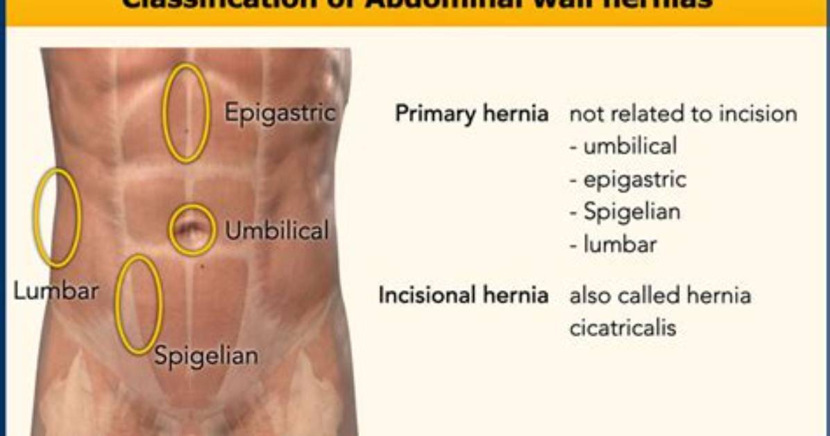 Where Do Spigelian Hernias Occur?