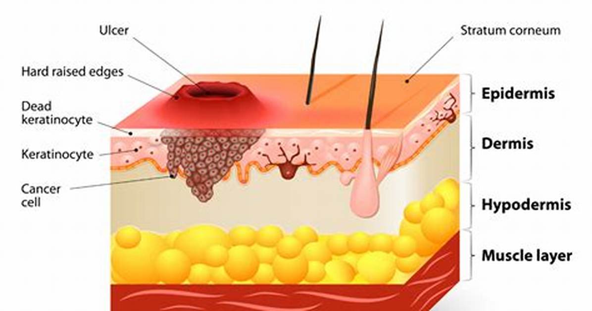 Where Do Squamous Cell Carcinomas Arise from?