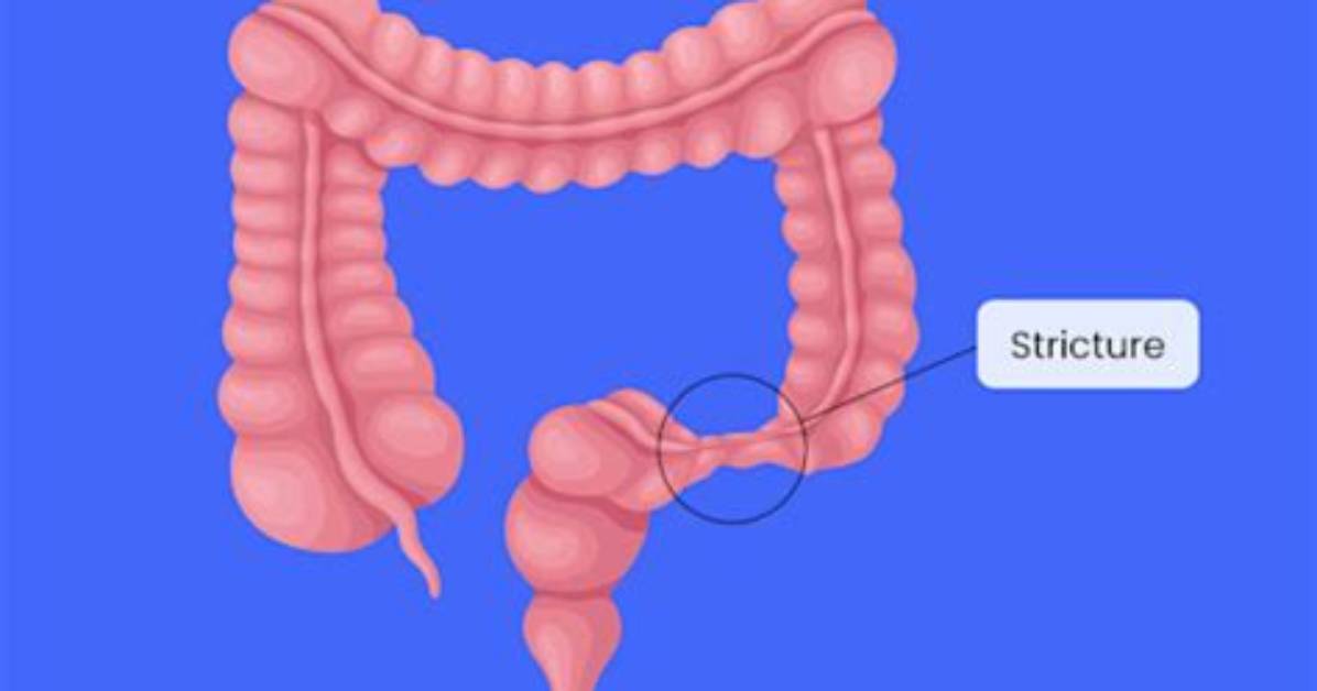 Where Do Strictures Occur?