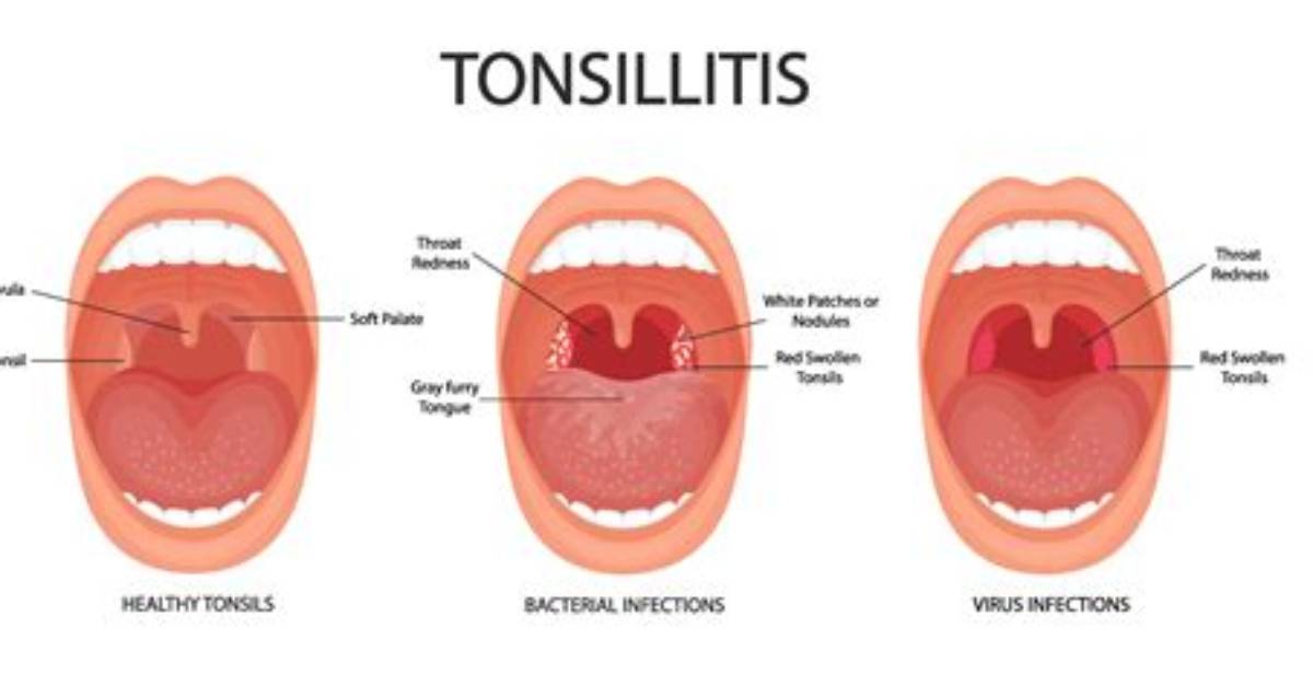Where Do the Tonsils Drain
