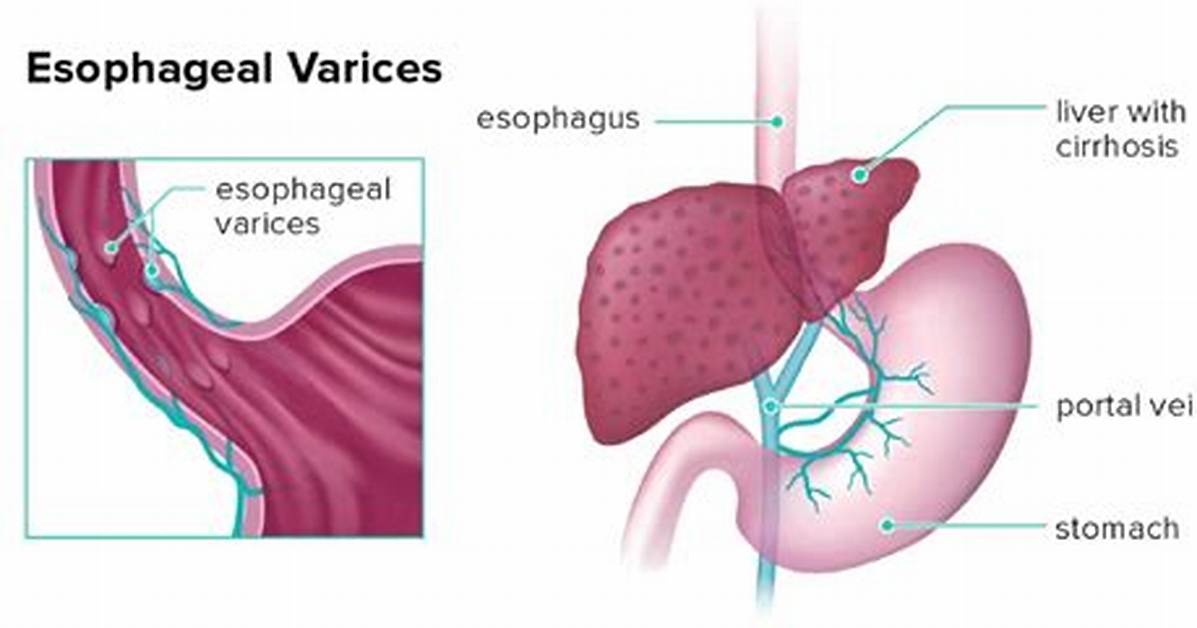 Where Do Varices Form?