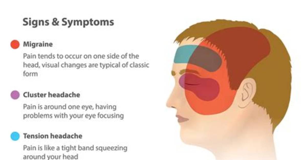 Where Do You Feel Migraines?