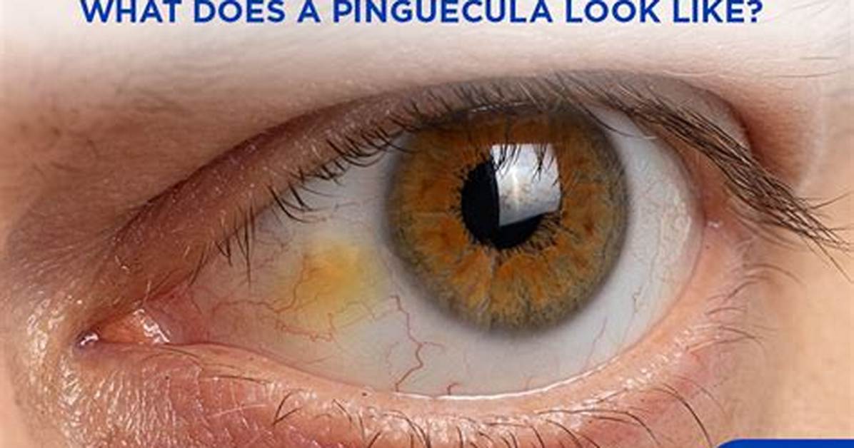 Where Do You Get Pinguecula?