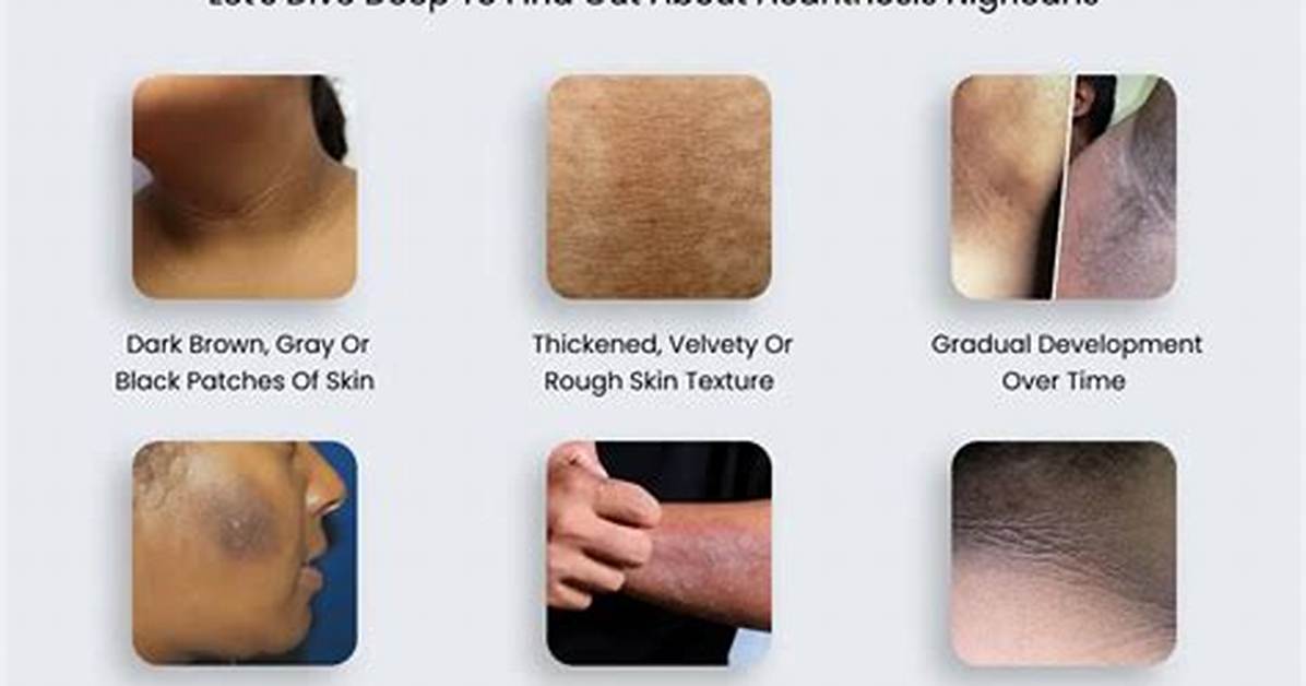 Where Does Acanthosis Nigricans Occur?