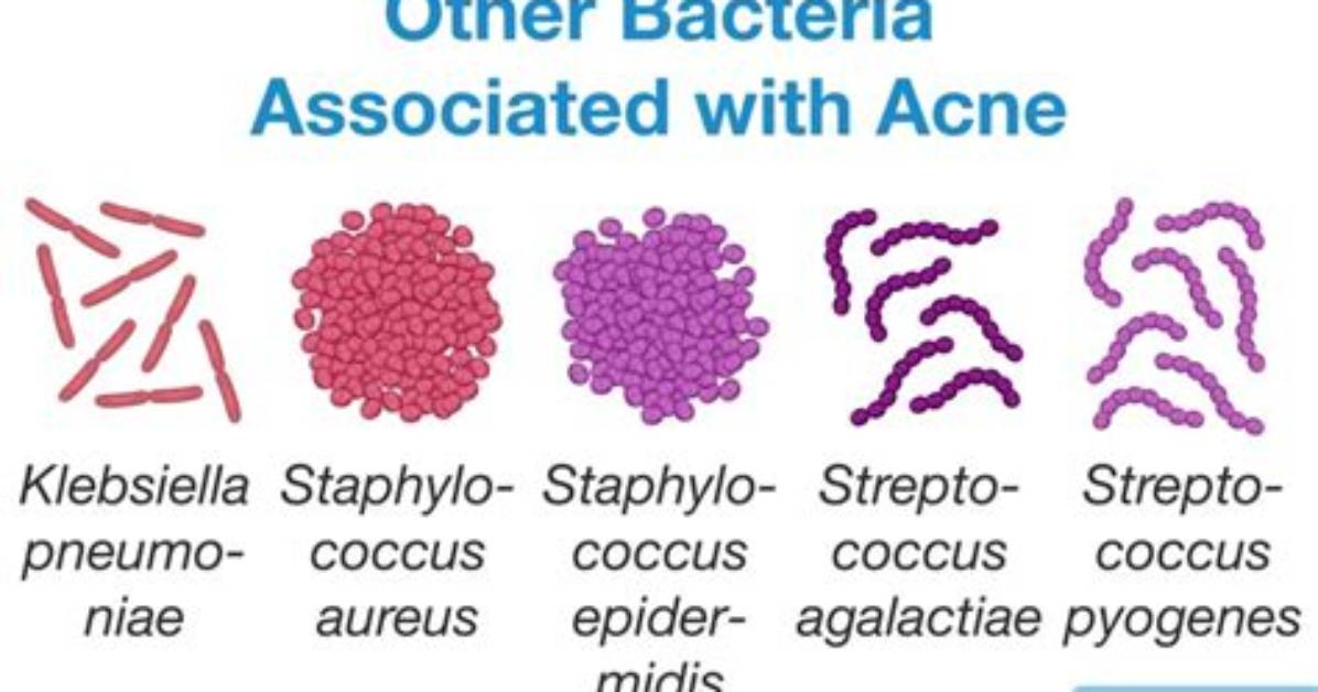 Where Does Acne Bacteria Come from?