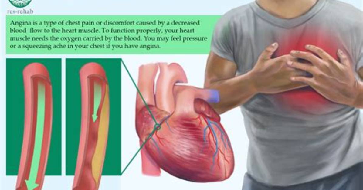 Where Does Angina Hurt?
