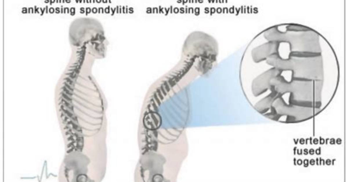 Where Does Ankylosing Spondylitis Affect?