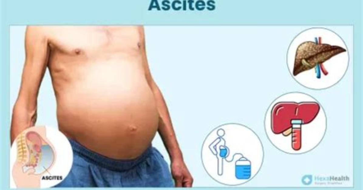 Where Does Ascites Come from?