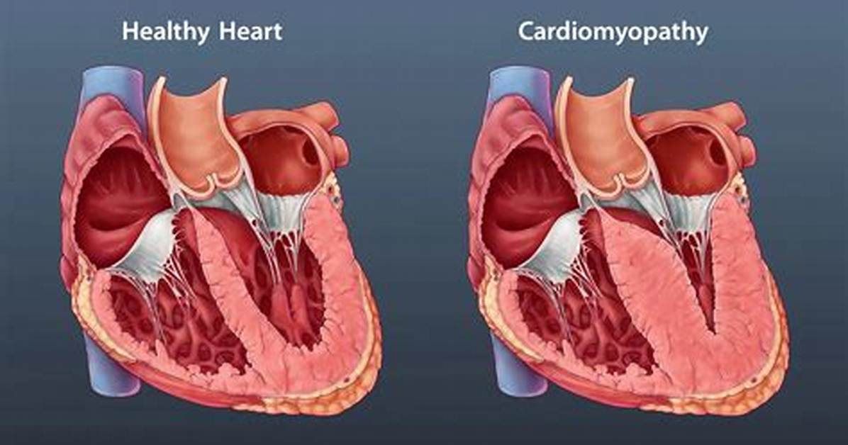 Where Does Cardiomyopathy Affect?