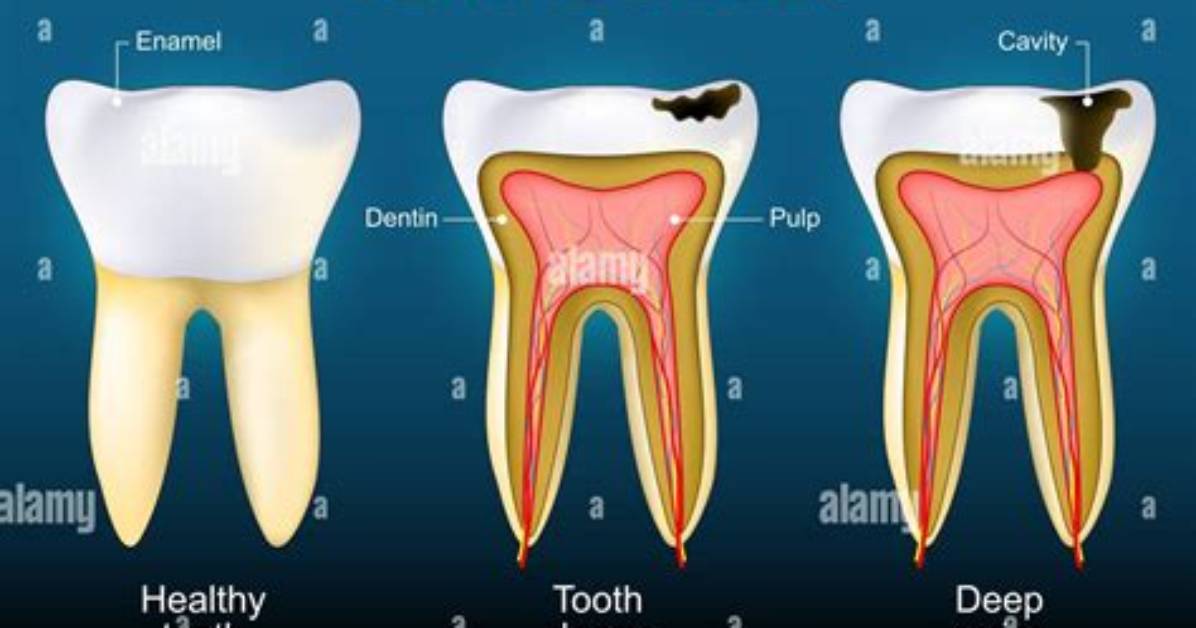 Where Does Caries Start?