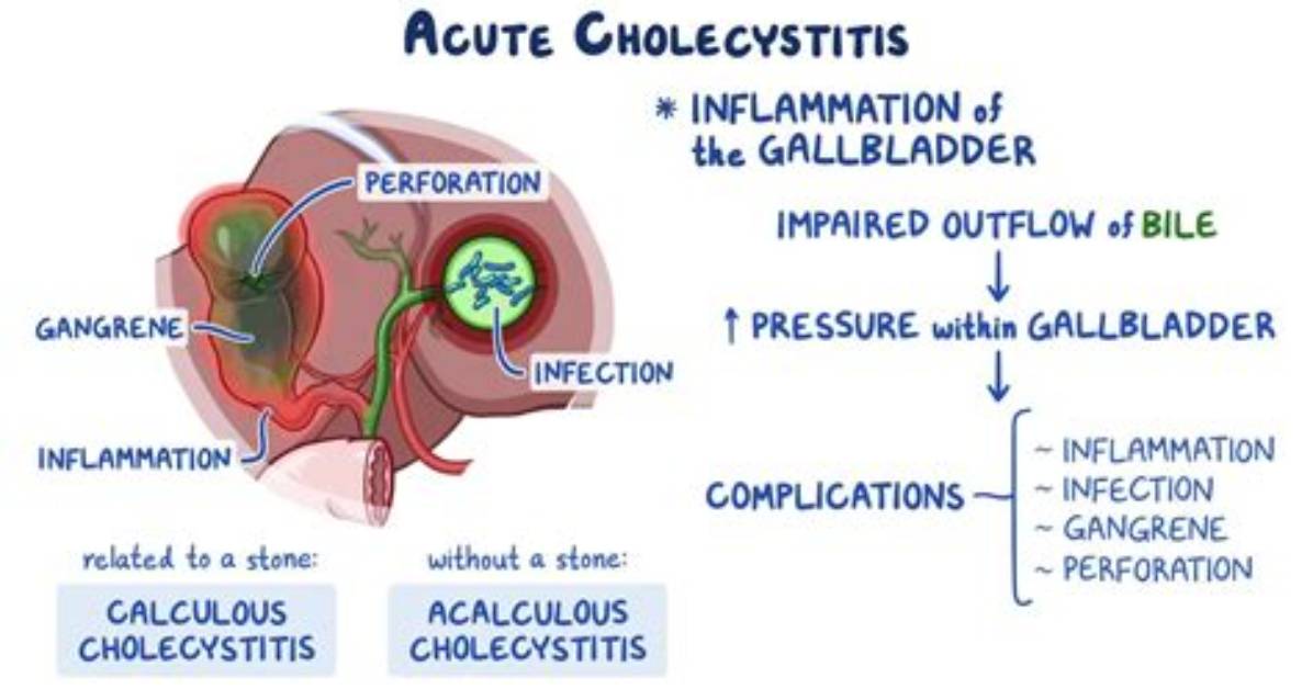 Where Does Cholecystitis Hurt?