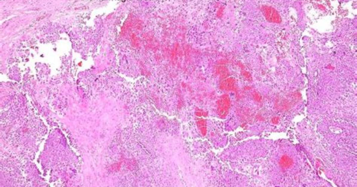 Where Does Choriocarcinoma Spread?