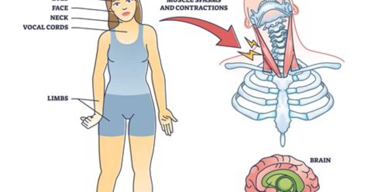 Where Does Dystonia Come from?